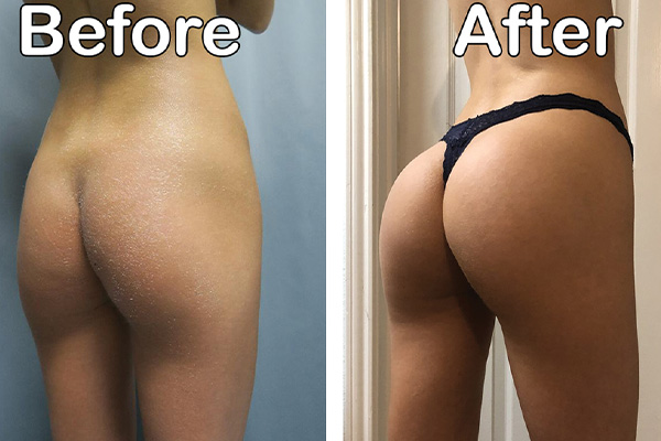 rear view of buttocks before and after augmentation
