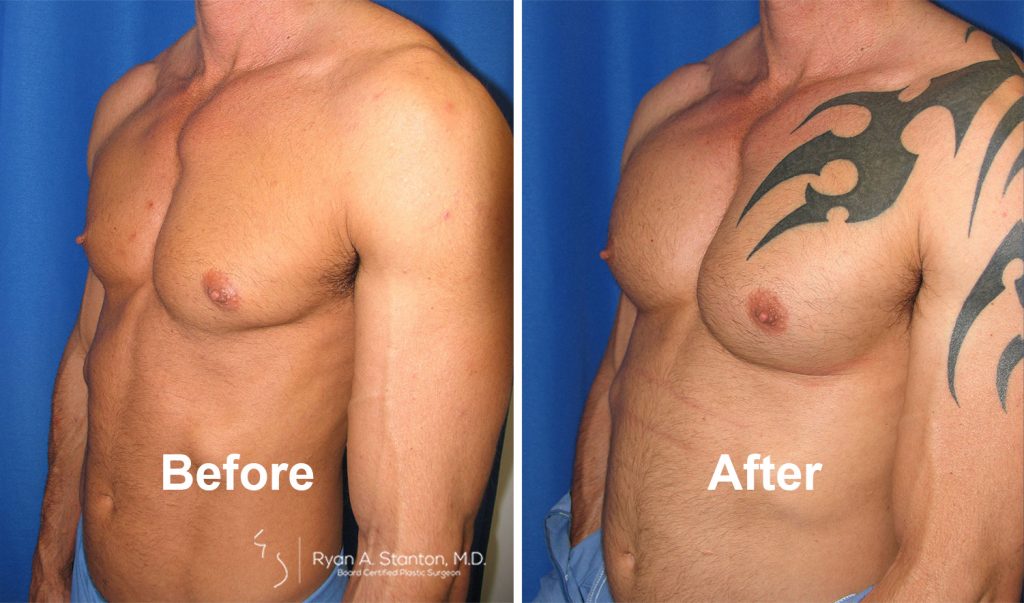 before and after pectoral implants on male patient
