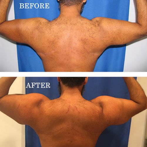 before and after bicep implants arms bent rear view of male patient 601