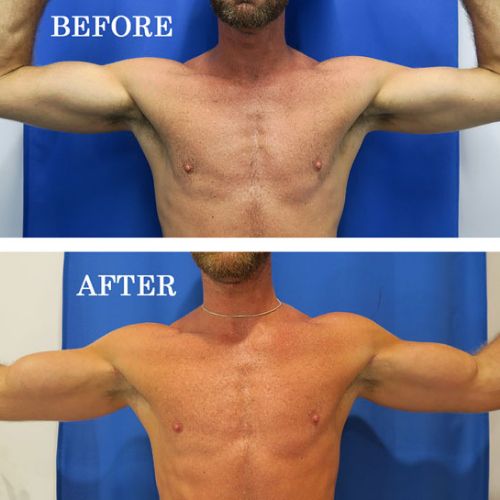 before and after bicep implants arms bent front view of male patient 601