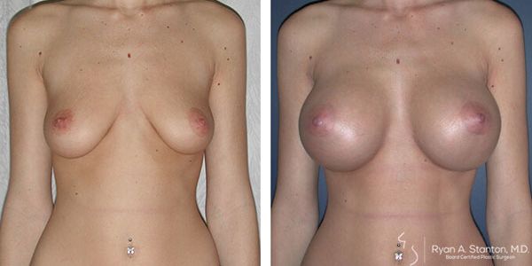 before and after breast augmentation front view of female patient 608