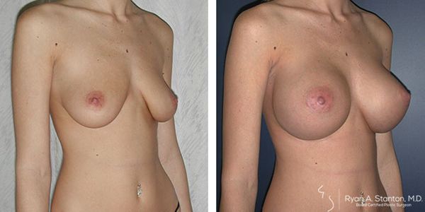 before and after breast augmentation right angle view of female patient 608