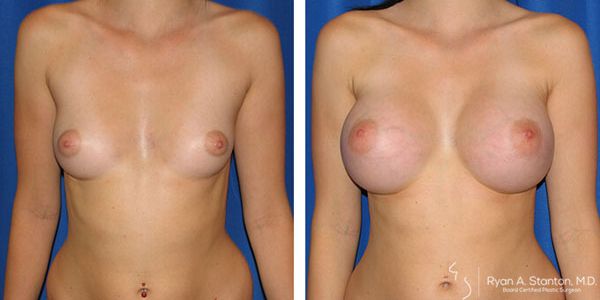before and after breast augmentation front view of female patient 614