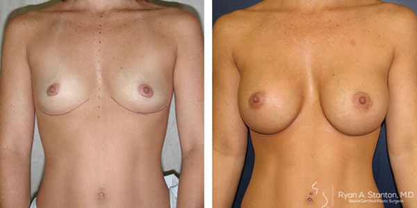 before and after breast augmentation front view of female patient 619