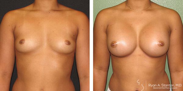 before and after breast augmentation front view of female patient 621