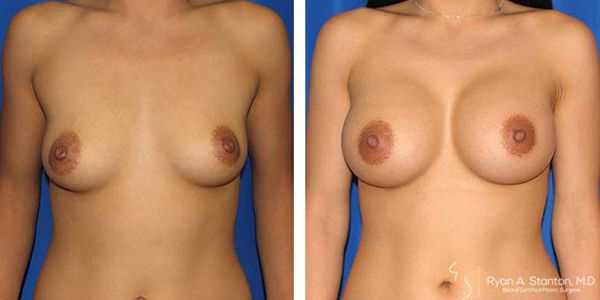 before and after breast augmentation front view of female patient 631
