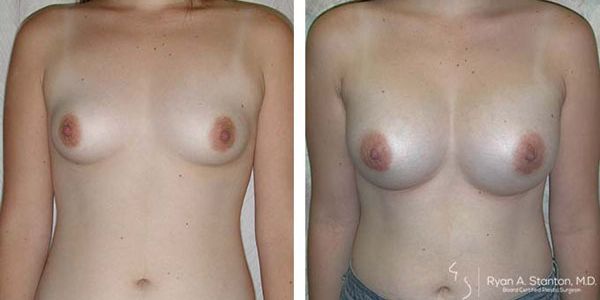 before and after breast augmentation front view of female patient 633