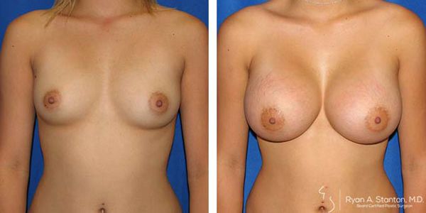 before and after breast augmentation front view of female patient 637