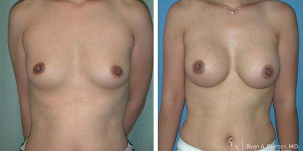 before and after breast augmentation front view of female patient 640