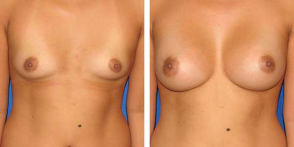 before and after breast augmentation front view of female patient 643