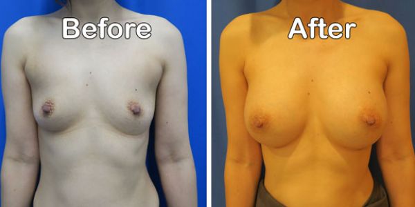 before and after breast augmentation front view of female patient 648
