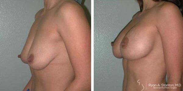 before and after breast lift left side view of female patient 658