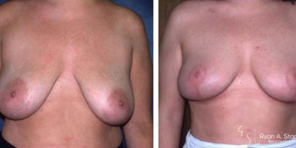 before and after breast lift front view of female patient 663