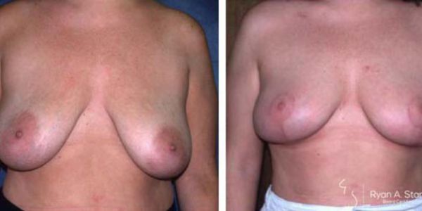 breast ptosis corrected with a breast lift