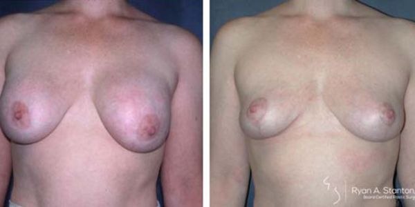 before and after breast lift front view of female patient 665