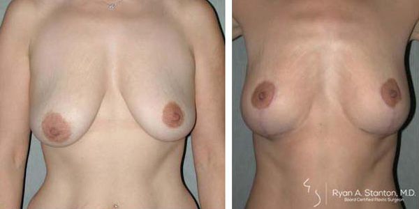 before and after breast lift front view of female patient 671