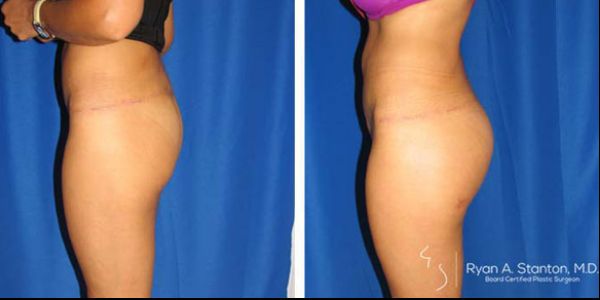 before and after buttock implant left side view female patient case 1008
