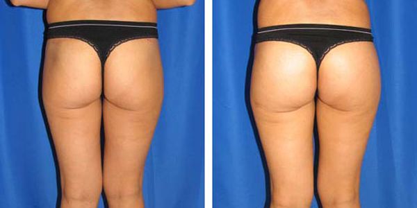 before and after buttock implant back view female patient case 1010