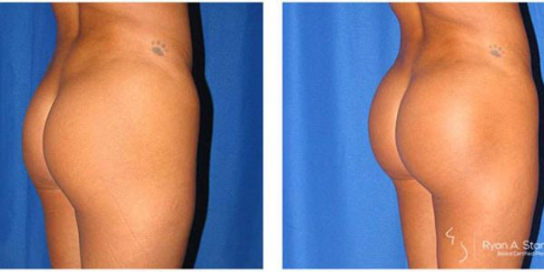 before and after buttock implant right angle view female patient case 1012