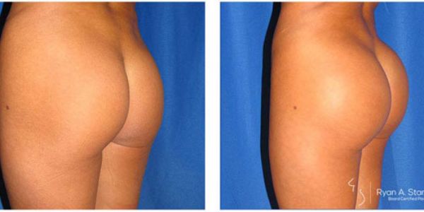 before and after buttock implant left angle view female patient case 1012
