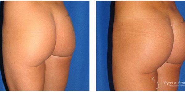 before and after buttock implant left angle view female patient case 1019
