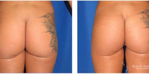 before and after buttock implant back view female patient case 1016