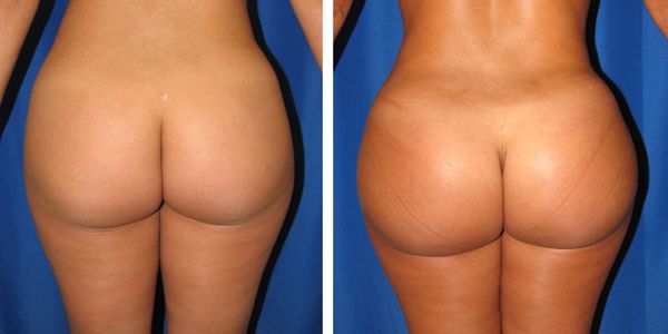 before and after buttock implant back view female patient case 1019