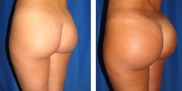 before and after buttock implant left angle view female patient case 1019