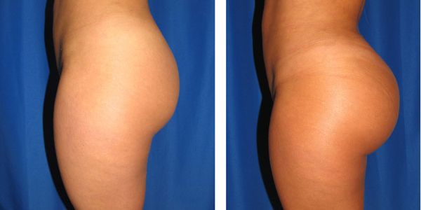 before and after buttock implant left side view female patient case 1019