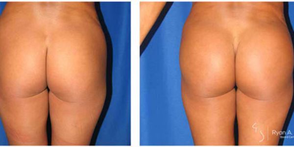 before and after buttock implant back view female patient case 1023