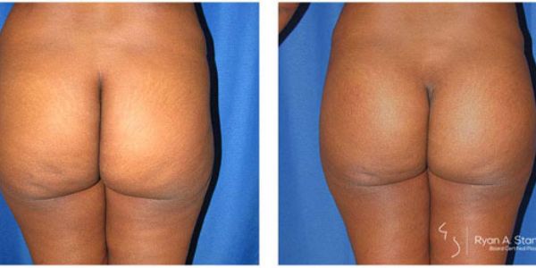 before and after buttock implant back view female patient case 1025