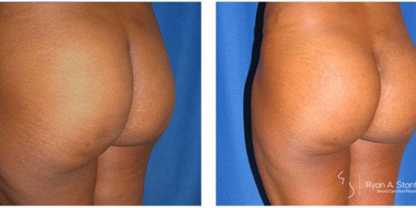 before and after buttock implant left angle view female patient case 1025
