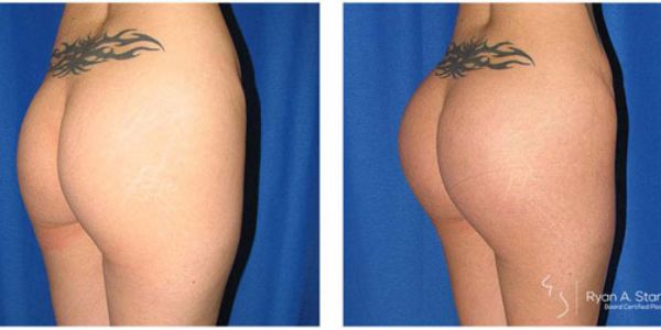 before and after buttock implant right angle view female patient case 1028