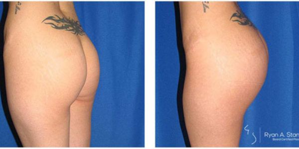 before and after buttock implant left side view female patient case 1028