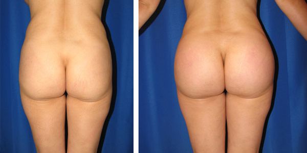 before and after buttock implant back view female patient case 1031
