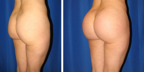 before and after buttock implant right angle view female patient case 1031