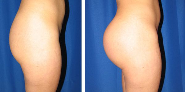before and after buttock implant right side view female patient case 1031