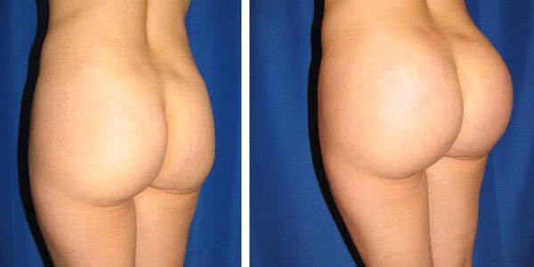 before and after buttock implant left angle view female patient case 1031