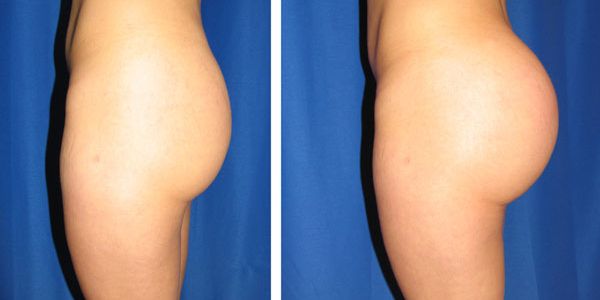 before and after buttock implant left side view female patient case 1031