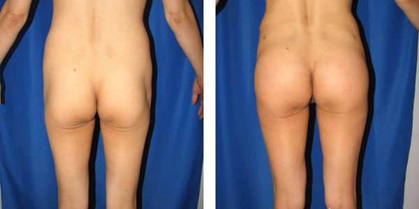 before and after buttock implant back view female patient case 1037