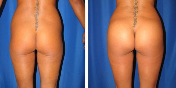 before and after buttock implant back view female patient case 1041