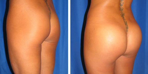 before and after buttock implant left angle view female patient case 1041
