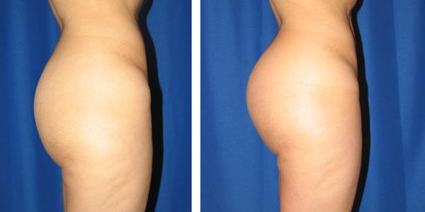 before and after buttock implant right side view female patient case 1045