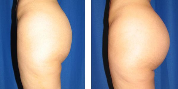 before and after buttock implant left side view female patient case 1045