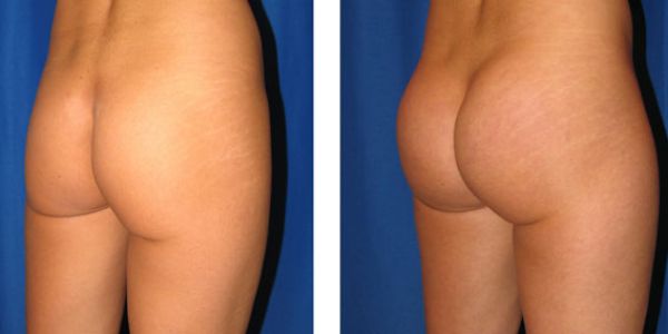 before and after buttock implant rightangle view female patient case 1048