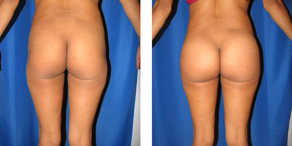 before and after buttock implant back view female patient case 1050