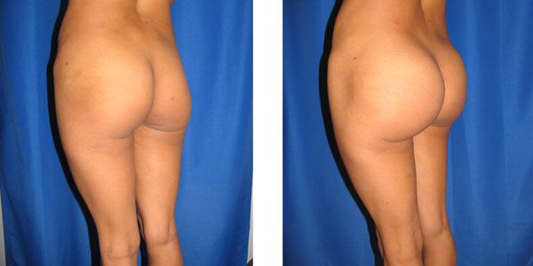 before and after buttock implant left angle view female patient case 1050