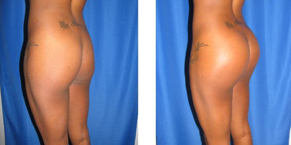 before and after buttock implant left angle view female patient case 1053