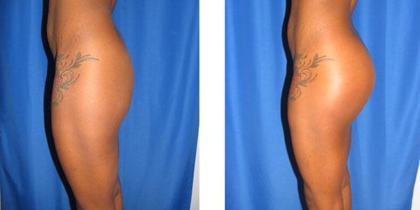 before and after buttock implant left side view female patient case 1053
