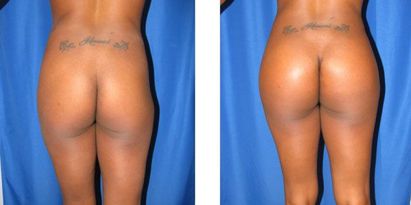 before and after buttock implant back view female patient case 1053